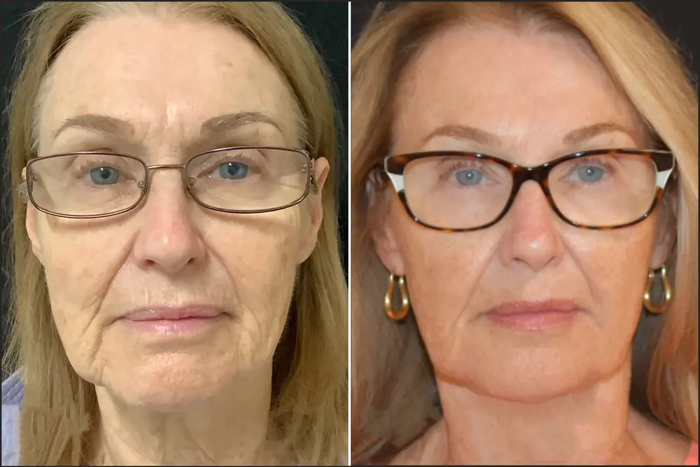 B&A3